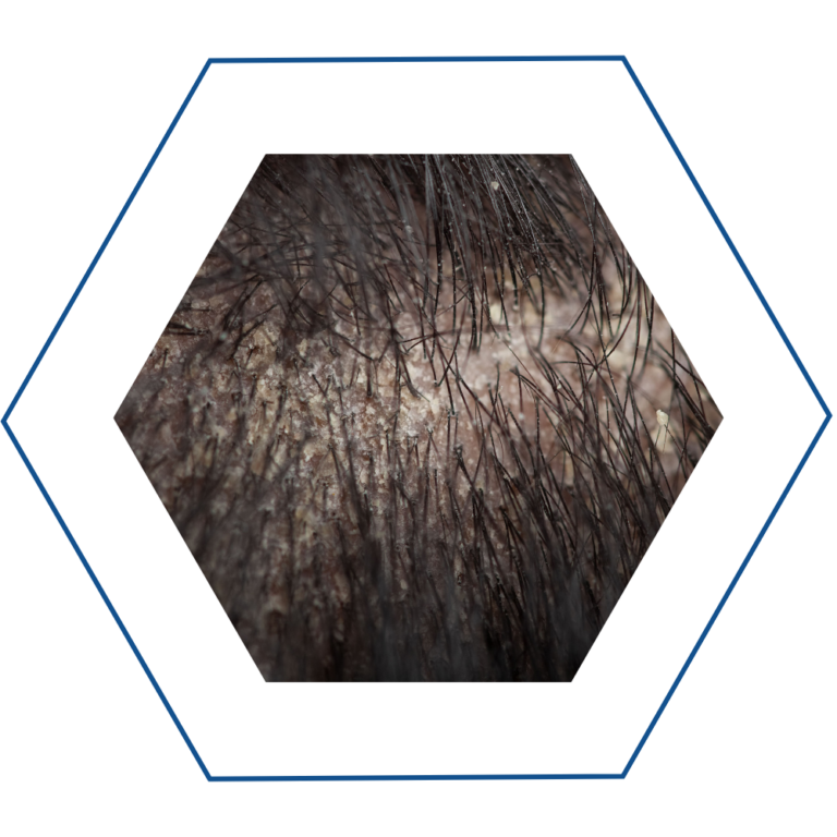 dermatite seborroica dermatite seborroica