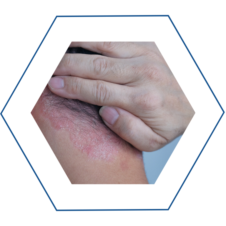 psoriasi psoriasi