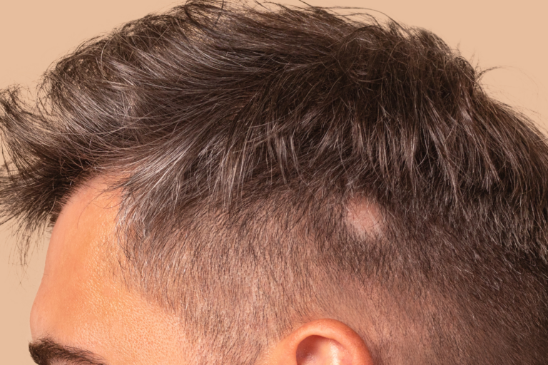 alopecia fisiologica o meno? uomo con alopecia non fisiologica