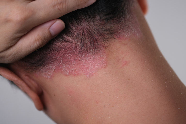 psoriasi del cuoio capelluto psoriasi del cuoio capelluto